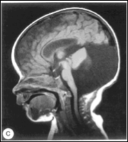 Dandy Walker Malformation
