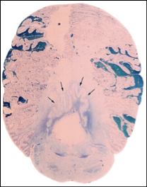Rhombencephalosynapsis